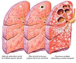 Resultado de imagen para tuberculosis
