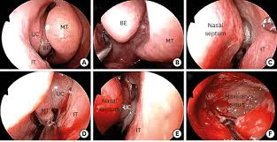 Image result for Sinus Surgery