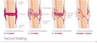 Bone Healing S53p4
