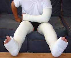 Image result for Long Arm Cast