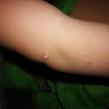 Imidlertid kan det noen ganger forekomme hos eldre barn og voksne. Vannkopper Barn Og Familie Kvinneguiden Forum