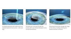Relex Smile Laser Eye Surgery Laser Eye Surgery Laser Eye Eye Surgery