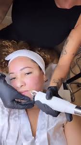 La radiofrecuencia fraccionada facial es un tratamiento estético no  quirúrgico que combina la energía de la radiofrecuencia con microagujas o  puntas fraccionadas para estimular la piel en capas ...