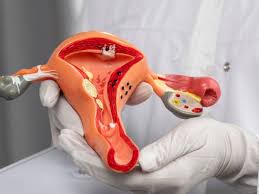 Surgical Vaginal tightening - Op. Dr. Ceren Katar Yıldırım