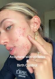 Accutane Before and After Purge