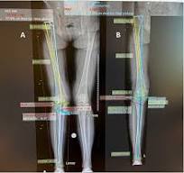 Knee valgus deformity: indications and outcomes for a high ...