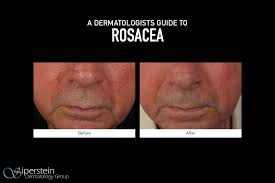 Ivermectin can be applied topically and also has an oral form, which is commonly used to treat mange in animals. What Triggers Rosacea And How Is It Treated