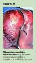 • identification of petechiae and purpura • think through broad differential • inpatient vs outpatient • bruise: Skin Lesions That Mimic Abuse