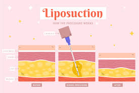 Image result for Liposuction