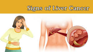 Most people with pancreatic cancer (and nearly all people with ampullary cancer) will have jaundice as one of their first symptoms. Signs Of Liver Cancer That Every Woman Needs To Know Womenworking