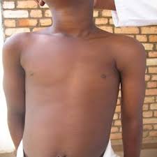 I have been told that i have tuberous breasts. 12 Year Old Boy With Poland Syndrome Note The Hypotrophic Left Download Scientific Diagram