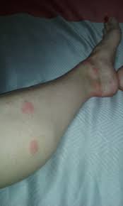 Bed Bug Photos Clipart Images Pics What Do Bed Bugs Look Like Here, bed bug bites pictures to help you figure it out, plus tips from entomologists on how to spot the symptoms. bed bug photos clipart images pics