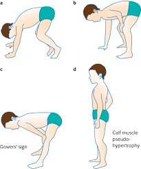 Get the top dmd abbreviation related to dentist. Duchenne Muscular Dystrophy The Bmj