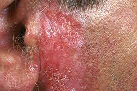 Lupus is perhaps the most typical one of autoimmune diseases. Hallmarks Of Systemic Lupus Erythematosus Rheumatology Advisor