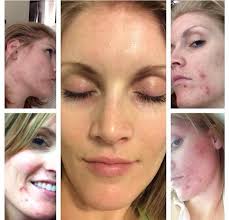 Norma Fatchen- Rodan + Fields Dermatologists