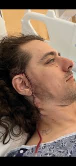 Experiences and recovery after melanoma surgery