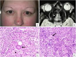 Image result for Dacryoadenitis