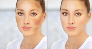 Image result for Diffuse Hyperpigmentation