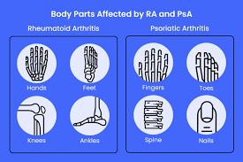 Image result for Rheumatoid Factor