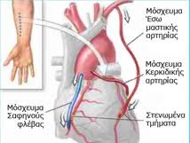 08 διαδερμικη στεφανιαια παρεμβαση σε στεφανιαιεσ αρτηριεσ με ανωμαλη εκφυση x. Stefaniaia Nosos Nikos Mpoympoylhs