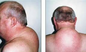Cushing Syndrome Russian Federation Pdf Ppt Case Reports Symptoms Treatment
