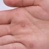 If you do have one of these warts, then you probably want it gone as soon as possible. 1