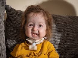 Girl with Benjamin Button-like condition which makes her look older starts  school