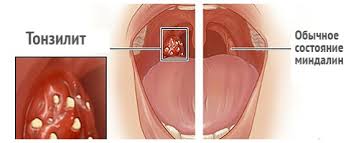 Nositelstvo Kak Izbavitsya Ot Streptococcus Pyogenes Navsegda Diagnostika I Lechenie Streptokokkovoj Infekcii