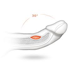 Here are six potential signs of peyronie's disease that you should speak up about: Peyronie S Disease Curved Penis Causes And Symptoms