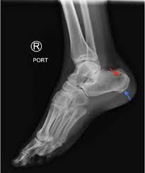 Image result for Calcaneus Compression Fracture