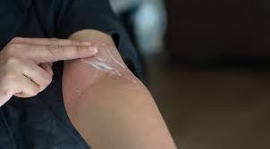 Deride Sisme Kizariklik Ve Kasinti Varsa Sanal Basin