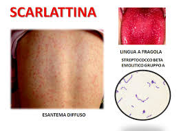 L'epidemia britannica la scarlattina è l'unica malattia esantematica dell'infanzia causata da un batterio, uno streptococco. Scarlattina