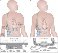 Your lungs may not work properly immediately after your surgery, so you may need to remain connected to a ventilator for a few days after surgery until y. Designs Of Lvads A Pulsatile Flow Devices Use Positive Displacement Download Scientific Diagram