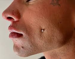 Armonización facial