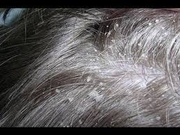 Seboreik Dermatit Nedir Sac Guzellik Kadin