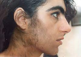 Sometimes hair loss becomes excessive and may there are several different types and patterns of hair loss which is collectively known as alopecia or commonly as balding. Hirsutism Increased Hair Growth In Women Women S Health Articles Family Health Center Steadyhealth Com