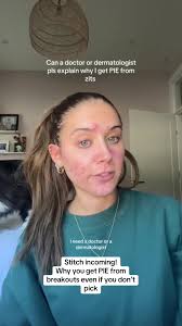 Kennedy Acne Journey Beef