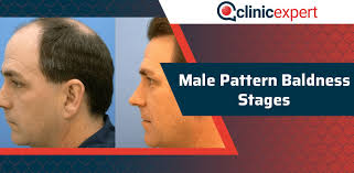 Female pattern hair loss is the commonest cause of hair loss in women and prevalence increases with advancing age. Male Pattern Baldness Stages Clinicexpert Healthcare