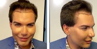 El ken humano, ahora barbie, sigue perdiendo la nariz pero se puso más nalgas rodrigo alves no deja de sorprender a sus fanáticos con sus nuevos cambios físicos, pues ahora el. Rodrigo Alves Transformation Human Ken Doll Unveils The Results Of His 70th Cosmetic Procedure After Spending Over 6k On Cosmetic Procedures Ok Magazine