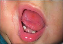 Greta tintin eleonora ernman thunberg ˈɡreːˌta ˈtʉːnˌbærj anhören? Jcdr Dysautonomia Familial Hereditary Sensory And Autonomic Neuropathy Type Iii