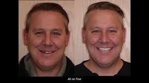 How Many Dental Implants Do I Need?