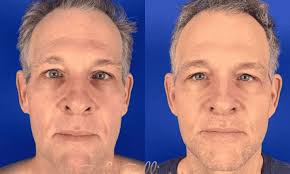 Face Lift (Face and Neck) Cost in Israel