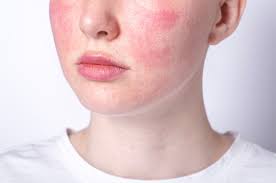 Red Skin Rosacea，Skin Condition