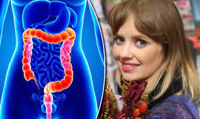When colon cancer is detected in its early stages, there may be no symptoms present at all. Bowel Cancer Symptoms Woman Said Signs Were The Same As Colitis Express Co Uk