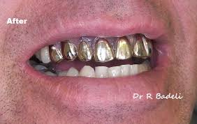 Since they do have a yellow or white gold color, gold crowns are used primarily to restore molars and premolars. Gold Tooth Gold Tooth Cap Gold Crown Tooth Gold Teeth Caps Front Teeth Br Deva Dental Clinic