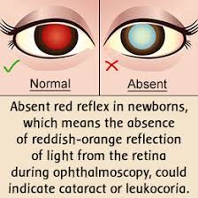 Image result for Red Reflex