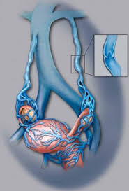 Pelvic Congestion Syndrome Center For Vein Care