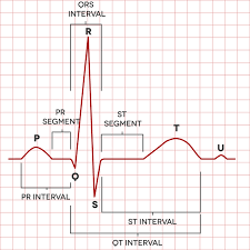 Sick Sinus Syndrome Medlineplus Genetics