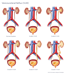 Vesicoureteral Reflux Vur Children S Hospital Of Philadelphia