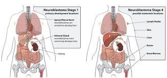 It most frequently starts from one of the adrenal glands but can also develop in the neck, chest, abdomen, or spine. Pin On Neuroblastoma